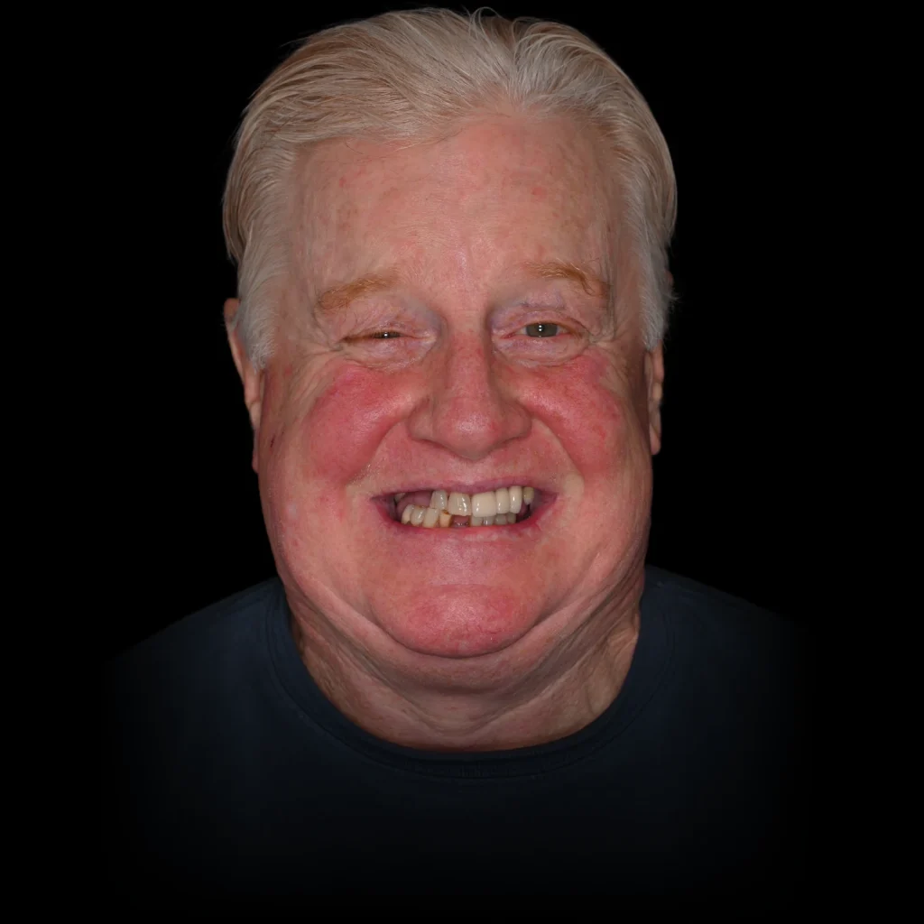 Patient before all on 4 dental implants at PRACTICENAME