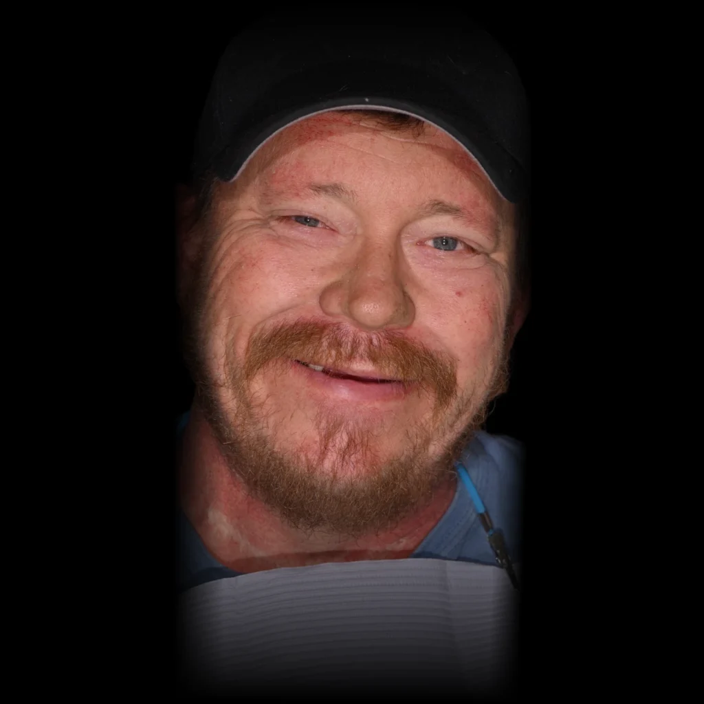 Patient before all on 4 dental implants at PRACTICENAME