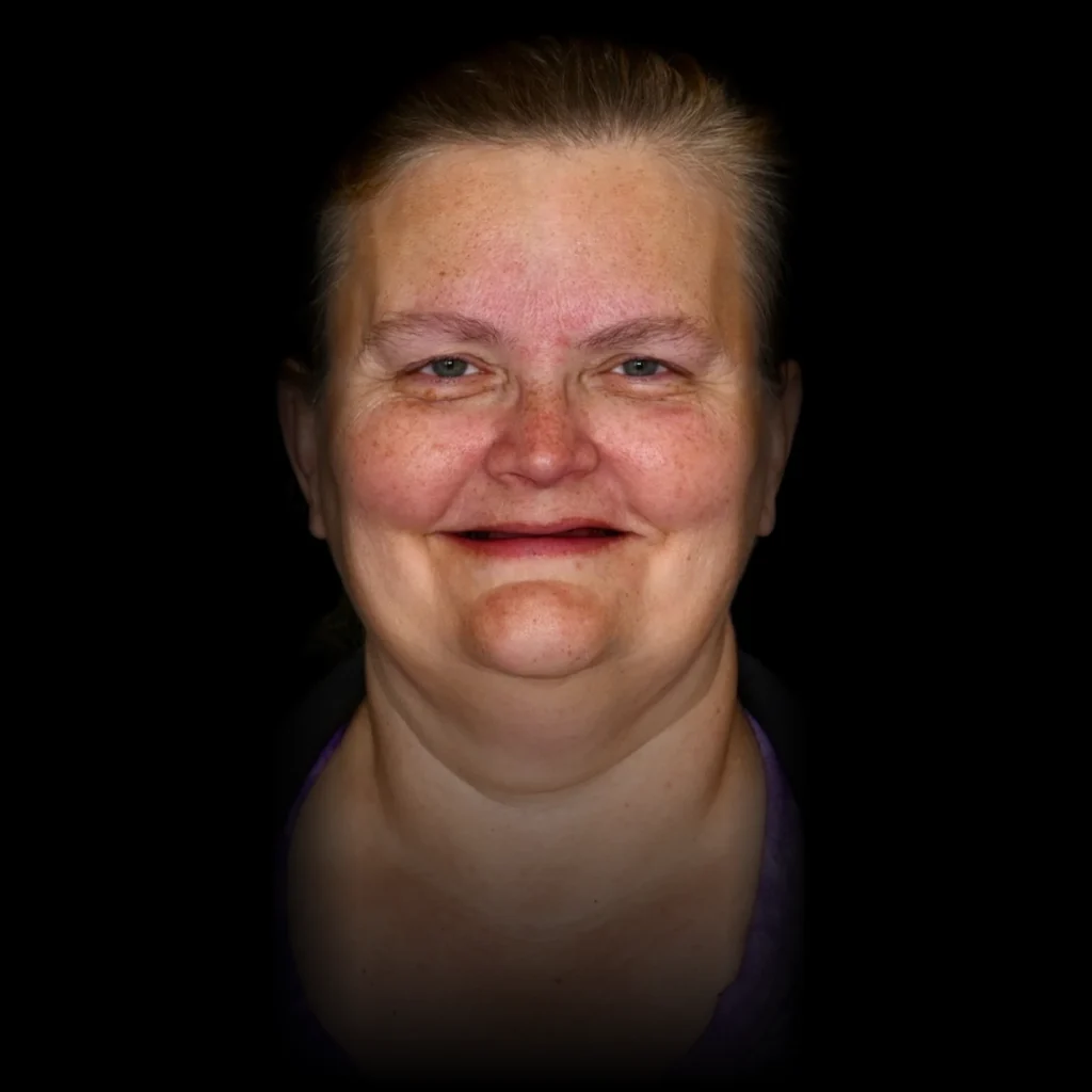 Patient before all on 4 dental implants at PRACTICENAME