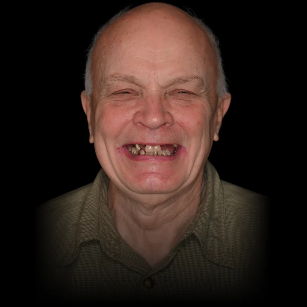 Patient before all on 4 dental implants at PRACTICENAME