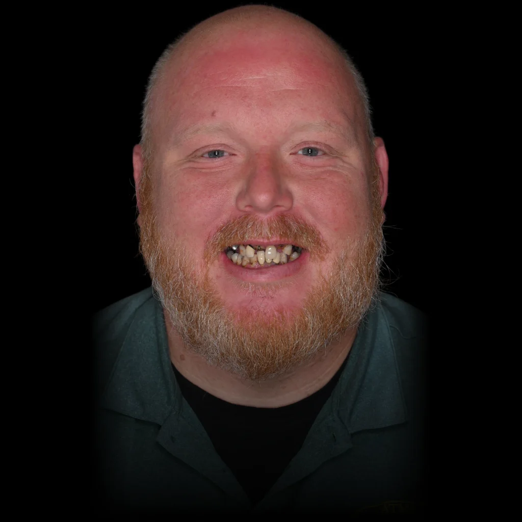 Patient before all on 4 dental implants at PRACTICENAME