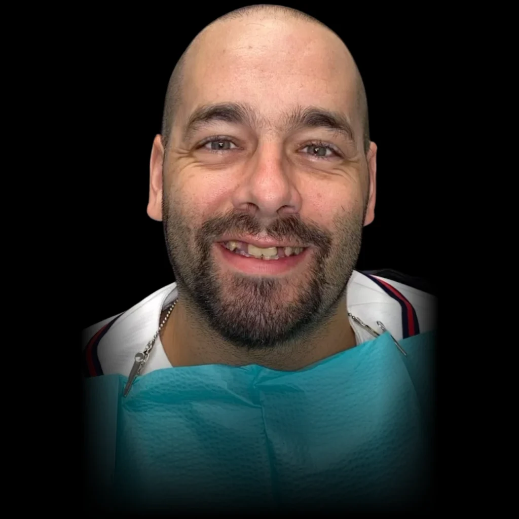 Patient before all on 4 dental implants at PRACTICENAME