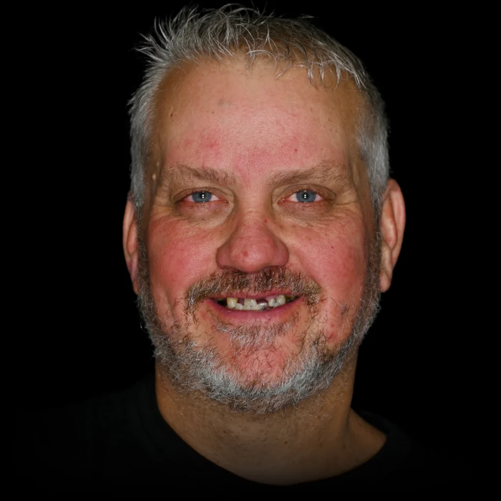 Patient before all on 4 dental implants at PRACTICENAME