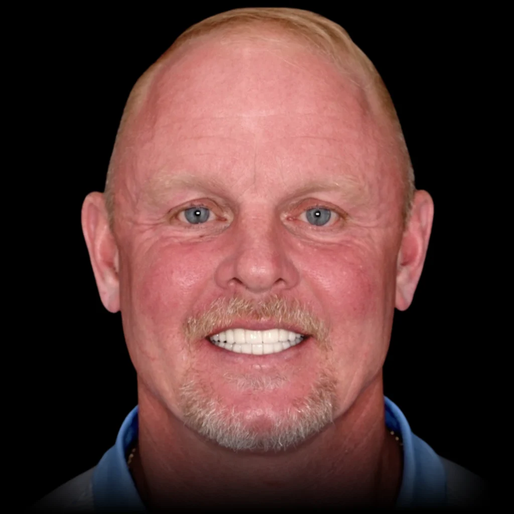 Patient smiling after all on 4 dental implants at PRACTICENAME