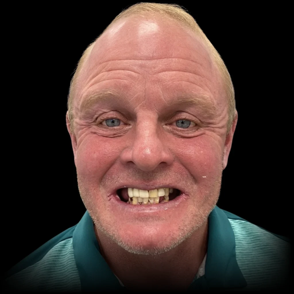 Patient before all on 4 dental implants at PRACTICENAME