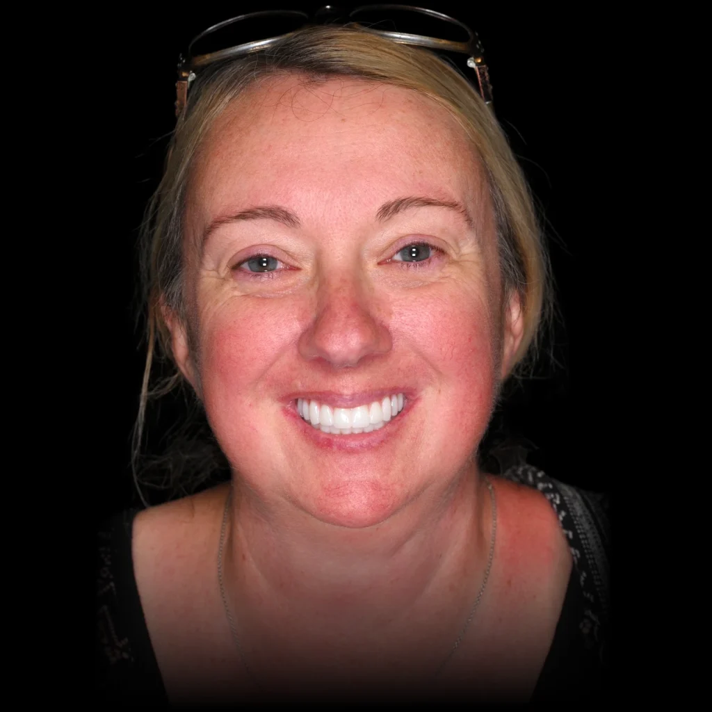 Patient after all on 4 dental implants at PRACTICENAME