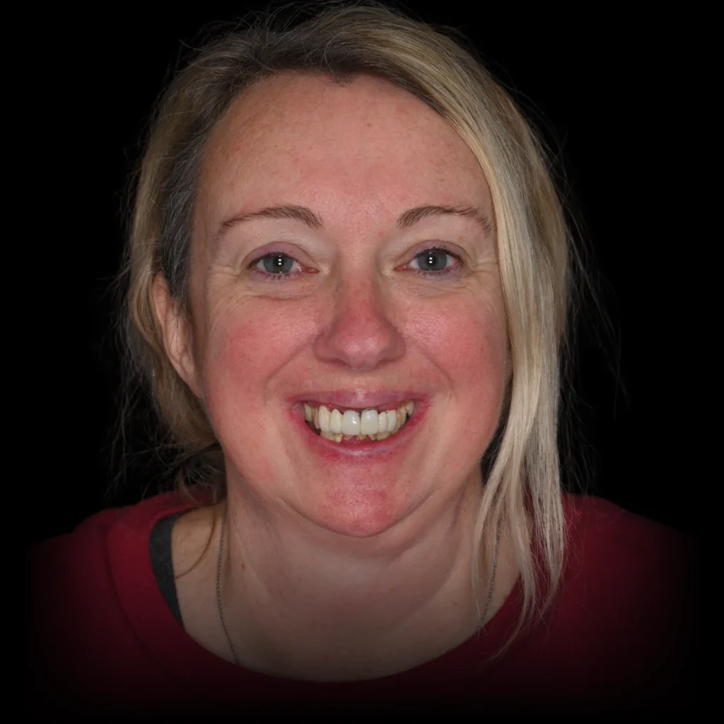 Patient before all on 4 dental implants at PRACTICENAME